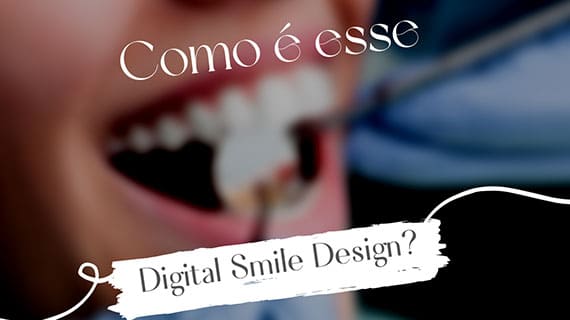 Digital Smile Design - Sorriso 3D