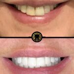 Facetas de porcelana