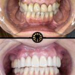 Facetas de porcelana