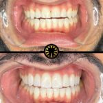 Facetas de porcelana