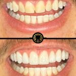 Facetas de porcelana