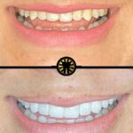 Facetas de porcelana