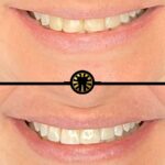 Facetas de porcelana