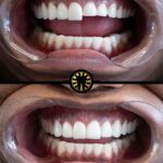 Facetas de porcelana