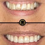 Facetas de porcelana