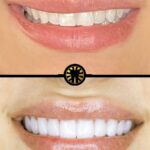 Facetas de porcelana